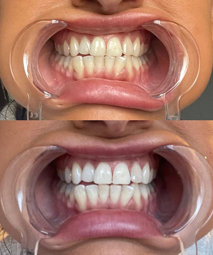 Purple Teeth Whitening Strips Oral Hygiene Fresh Breath Brighten Tooth Bleaching Long Lasting Oral Care Tooth Whitener Patches